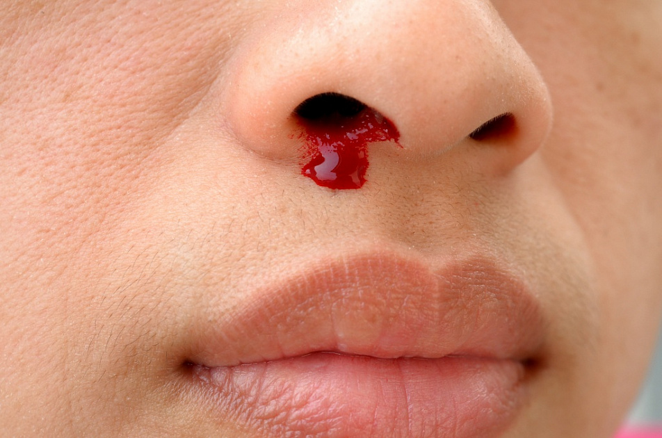 Симптомы носового кровотечения